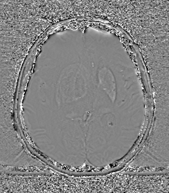 Cerebral metastasis to basal ganglia (Radiopaedia 81568-95413 Axial SWI phase 43).png