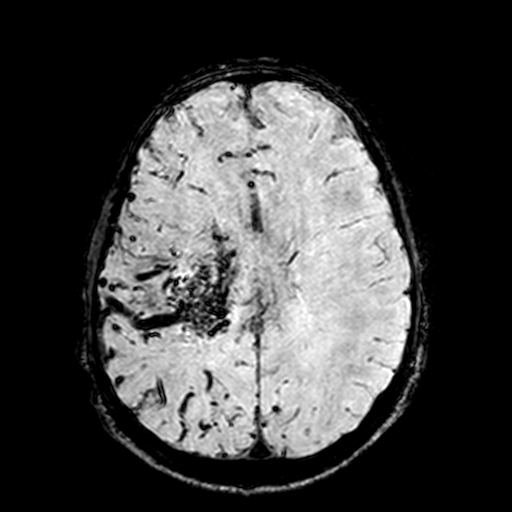 Cerebral parenchymal arteriovenous malformation (Radiopaedia 27280-27456 Axial SWI 77).jpg