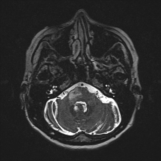 Cerebral ring enhancing lesions - cerebral metastases (Radiopaedia 44922-48817 F 29).jpg