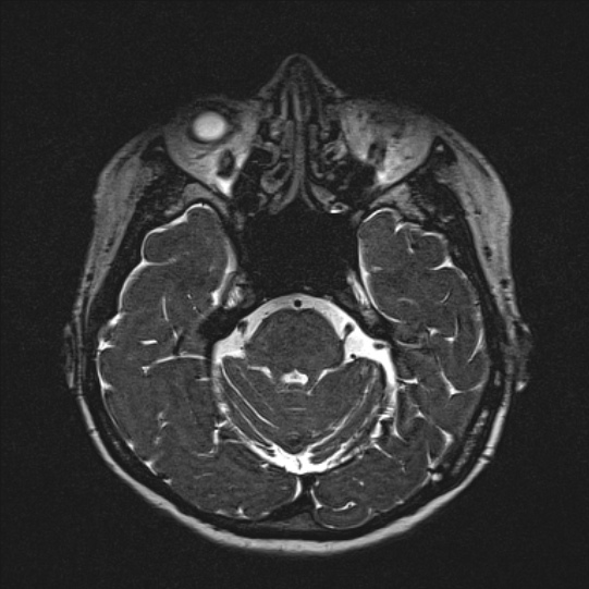Cerebral ring enhancing lesions - cerebral metastases (Radiopaedia 44922-48817 F 49).jpg