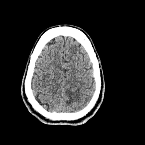 File:Cerebral toxoplasmosis (Radiopaedia 53993-60131 Axial non-contrast 65).jpg