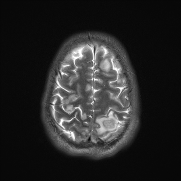 File:Cerebral toxoplasmosis (Radiopaedia 53993-60132 Axial T2 23).jpg