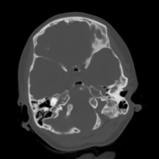 Cerebral tuberculosis with dural sinus invasion (Radiopaedia 60353-68018 Axial bone window 11).jpg