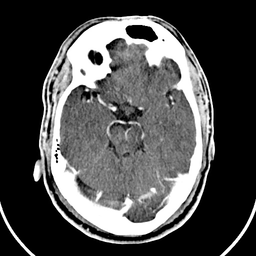 File:Cerebral venous angioma (Radiopaedia 69959-79977 B 26).jpg