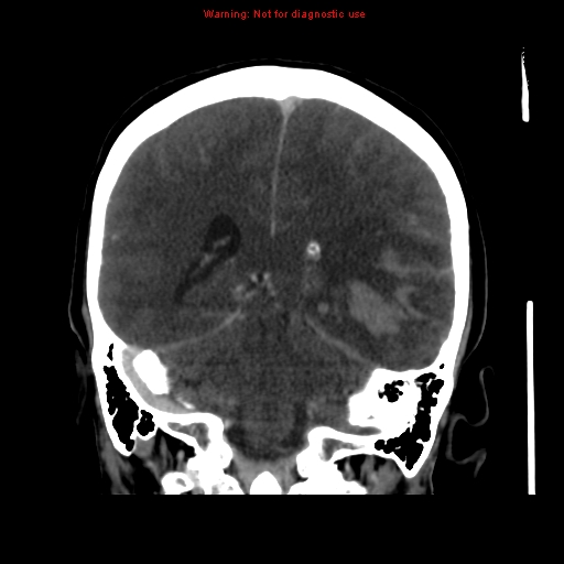 Cerebral venous infarction (Radiopaedia 12404-20735 B 53).jpg