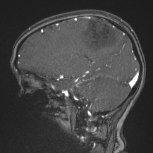 Cerebral venous infarction - hemorrhagic (Radiopaedia 81625-95505 Sagittal MRV 32).jpg