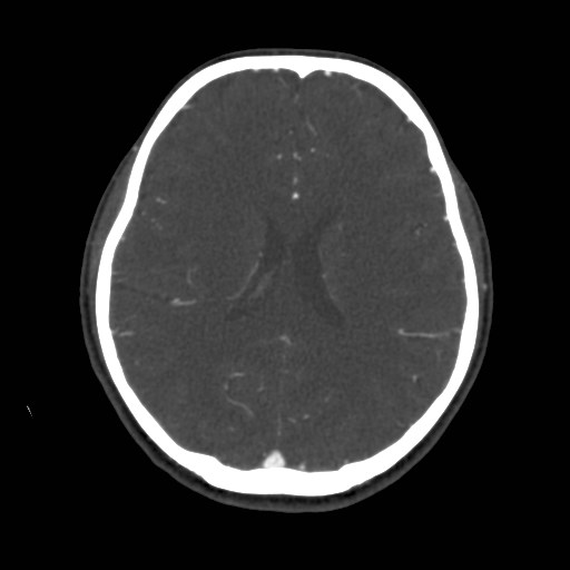 Cerebral venous sinus thrombosis (Radiopaedia 40619-43227 A 139).jpg