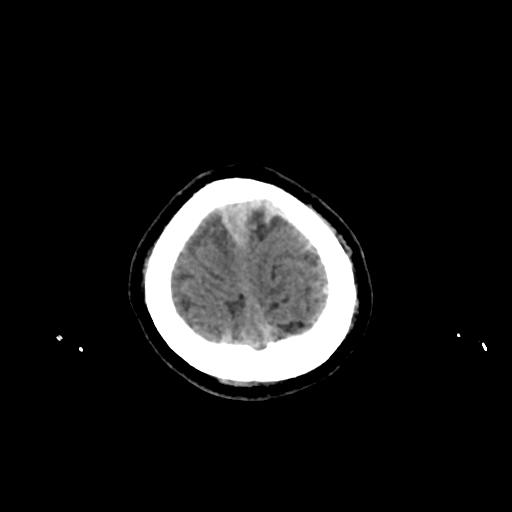 Cerebral venous throbmosis - hemorrhagic venous infarction (Radiopaedia 87318-103613 Axial non-contrast 163).jpg