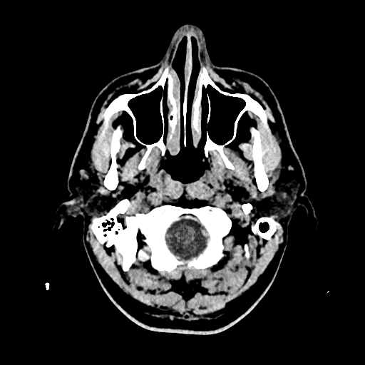 File:Cerebral venous thrombosis (CVT) (Radiopaedia 77524-89685 Axial non-contrast 2).jpg