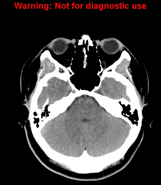 File:Cerebral venous thrombosis (Radiopaedia 37224-38992 Axial non-contrast 8).jpg