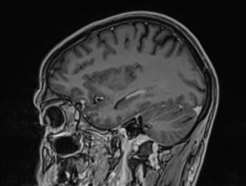 Cerebral venous thrombosis (Radiopaedia 71207-81504 Sagittal T1 C+ 16).jpg