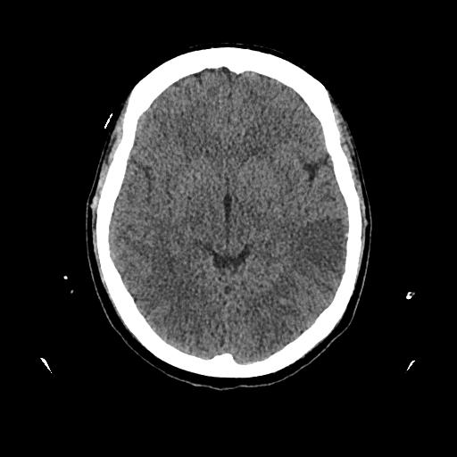 Cerebral venous thrombosis with venous hemorrhagic infarct (Radiopaedia 90354-107660 Axial non-contrast 24).jpg