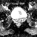 File:Cervical adenocarcinoma (Radiopaedia 65011-73985 Axial ADC 12).jpg