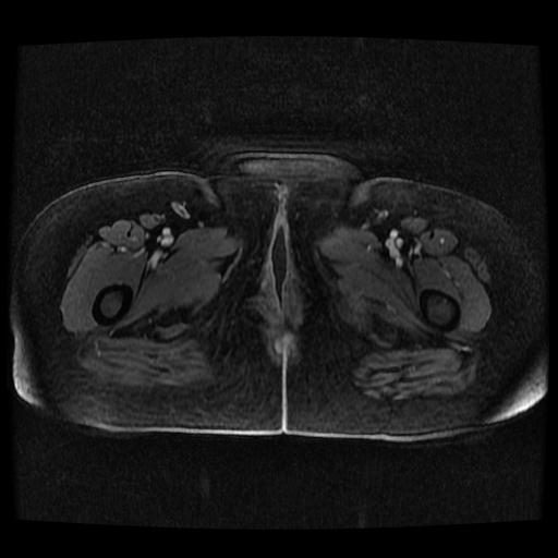 Cervical carcinoma (Radiopaedia 70924-81132 Axial T1 C+ fat sat 102).jpg