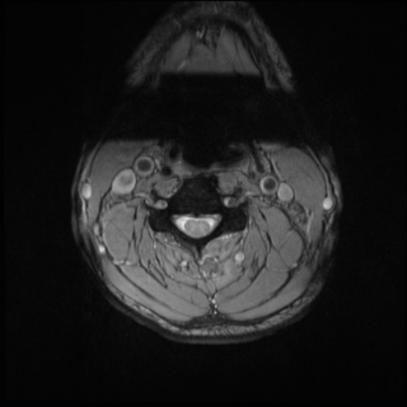 File:Cervical disc extrusion (Radiopaedia 53950-60077 Axial T2 13).jpg