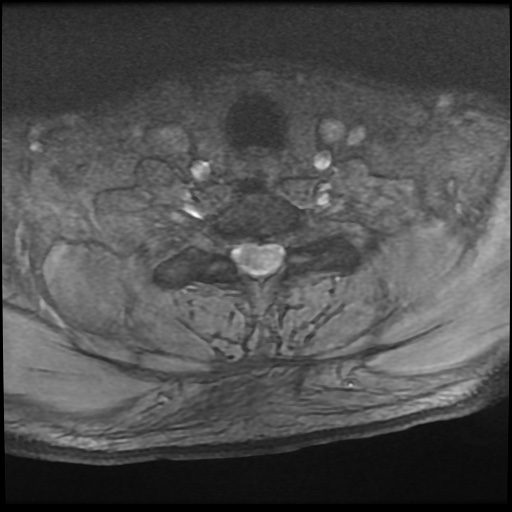 Cervical disc extrusion (Radiopaedia 59074-66364 F 51).jpg
