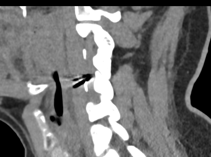 File:Cervical disc replacement (Radiopaedia 44025-47541 B 40).png