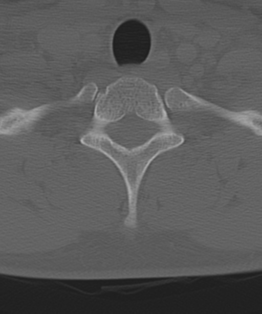 Cervical intercalary bone (Radiopaedia 35211-36748 Axial bone window 58).png