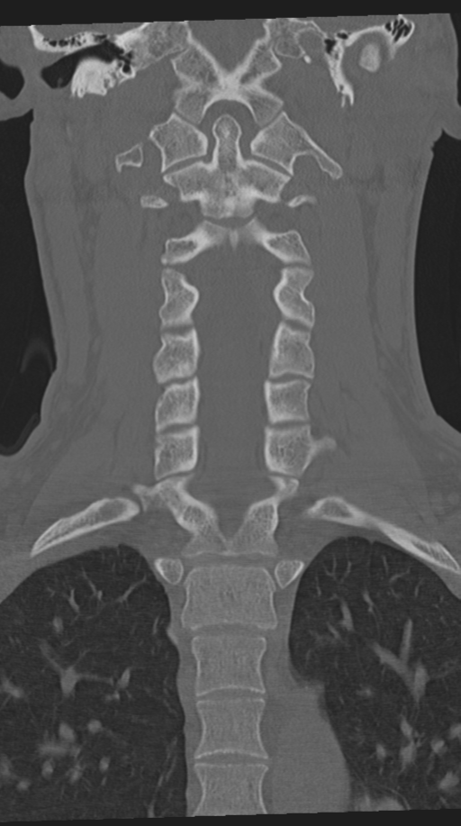 Cervical intercalary bone (Radiopaedia 35211-36748 Coronal bone window 40).png