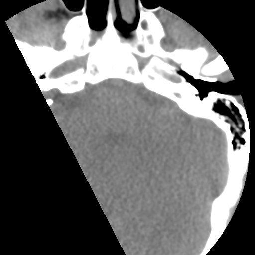 Cervical schwannoma (Radiopaedia 57979-64974 Axial non-contrast 3).png