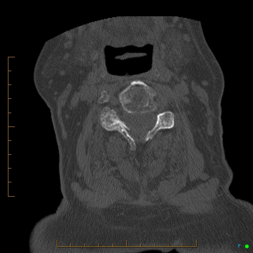 Cervical spine fracture - ankylosing spondylitis (Radiopaedia 76835-88706 Axial bone window 95).jpg