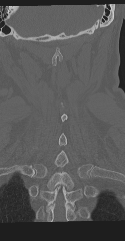 Cervical spine fracture in the setting of ankylosis (Radiopaedia 37038-38715 Coronal bone window 55).png