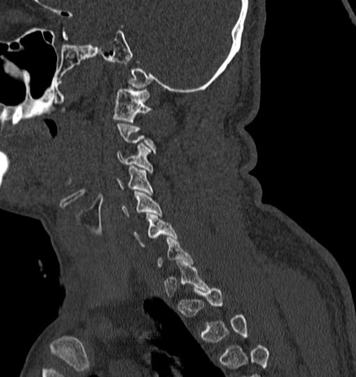Cervical spine trauma with tear drop fracture and perched facet joint (Radiopaedia 53989-60127 Sagittal bone window 32).jpg