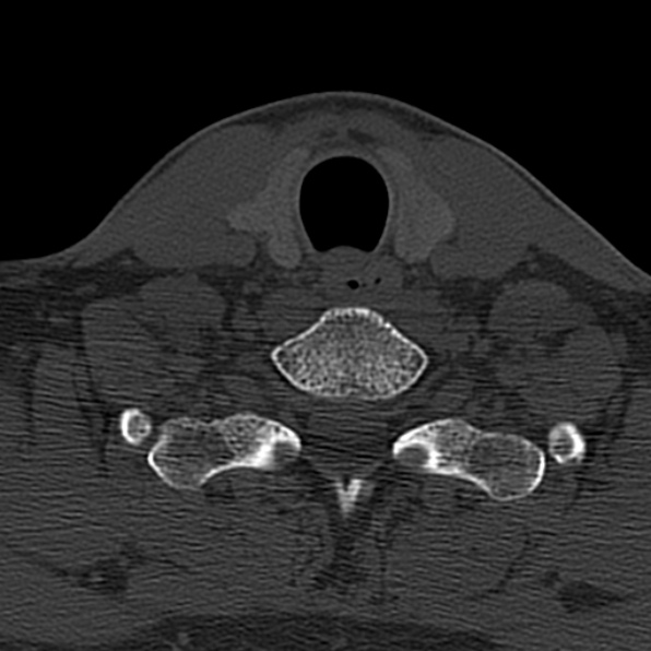 Cervical spondylodiscitis (Radiopaedia 28057-29489 Axial bone window 64).jpg