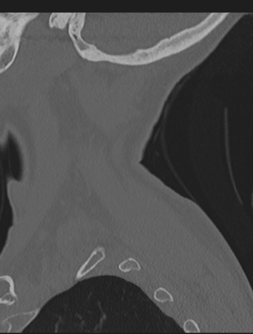 Cervical spondylolysis (Radiopaedia 49616-54811 Sagittal bone window 7).png