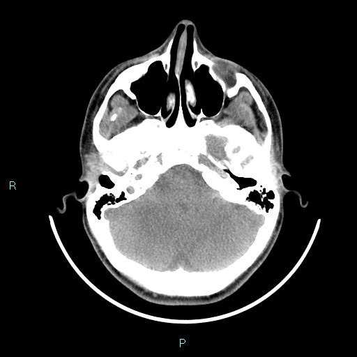 Cervical thymic cyst (Radiopaedia 88632-105335 Axial non-contrast 111).jpg