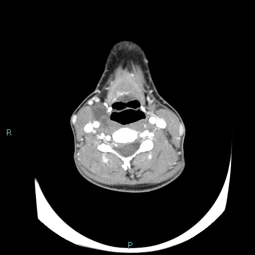 File:Cervical thymic cyst (Radiopaedia 88632-105335 B 60).jpg