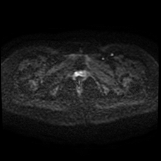 Cesarian section scar endometriosis (Radiopaedia 66520-75799 Axial DWI 100).jpg