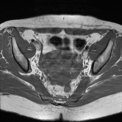 File:Cesarian section scar endometriosis (Radiopaedia 66520-75799 Axial T1 10).jpg