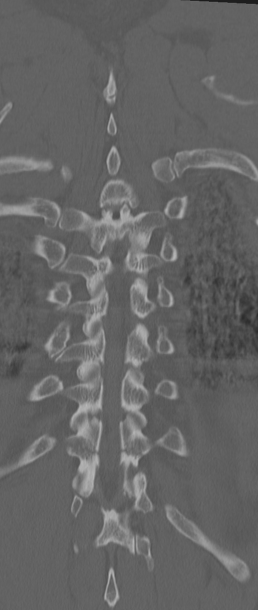 Chance fracture (Radiopaedia 33854-35020 Coronal bone window 68).png