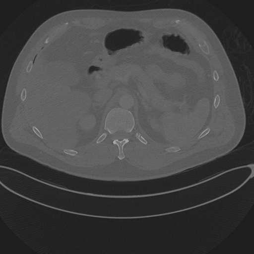 File:Chest multitrauma - aortic injury (Radiopaedia 34708-36147 Axial bone window 301).png