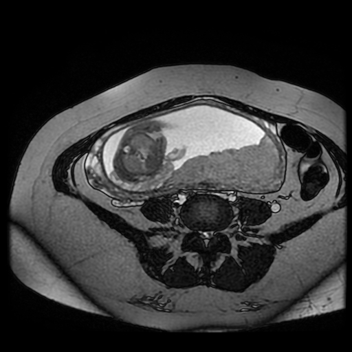 Chiari II malformation - fetal MRI (Radiopaedia 68099-77581 Axial Fiesta 24).jpg