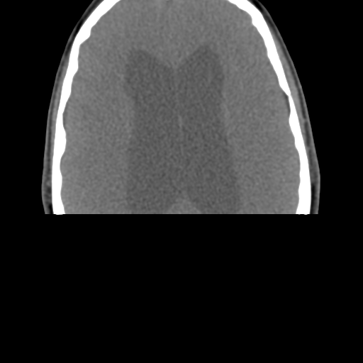File:Chiari I malformation and obstructive hydrocephalus (Radiopaedia 41185-43981 D 3).png