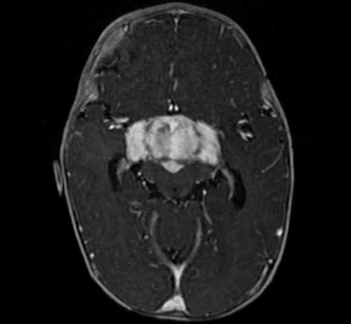 Chiasmatic-hypothalamic glioma (Radiopaedia 90079-107252 Axial T1 C+ 35).jpg