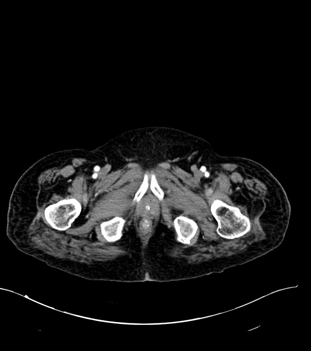 Cholangiocarcinoma with cerebral metastases (Radiopaedia 83519-98629 B 130).jpg