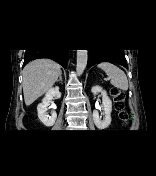 Cholangiocarcinoma with cerebral metastases (Radiopaedia 83519-98629 Coronal C+ delayed 54).jpg