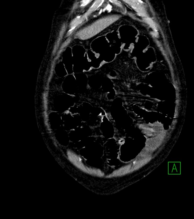 Cholangiocarcinoma with cerebral metastases (Radiopaedia 83519-98629 E 16).jpg