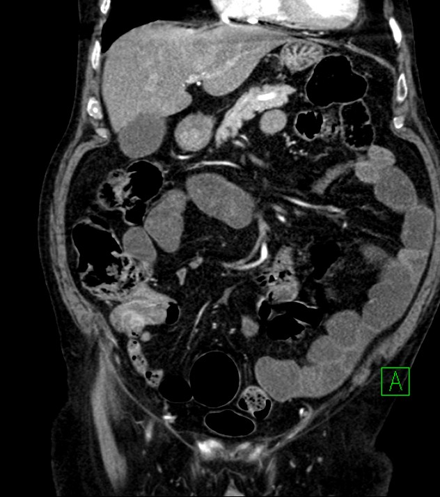 Cholangiocarcinoma with cerebral metastases (Radiopaedia 83519-98629 E 34).jpg