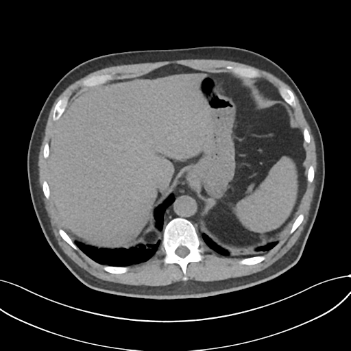 File:Cholecystitis with focal perforation and hepatic abscess (Radiopaedia 37189-38945 Axial non-contrast 16).png
