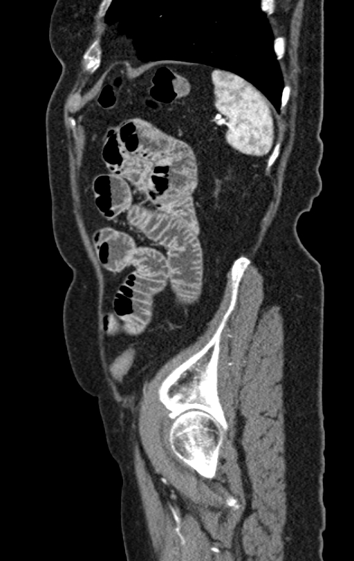 Cholecystoduodenal fistula due to calculous cholecystitis with gallstone migration (Radiopaedia 86875-103077 C 11).jpg