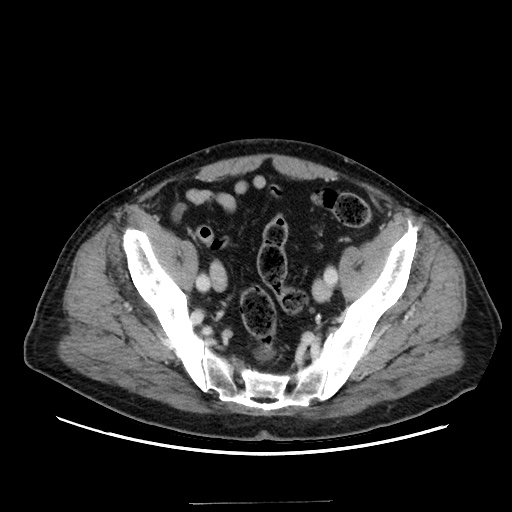 Choledocholiathiasis with normal caliber common bile duct (Radiopaedia 75368-86632 A 158).jpg