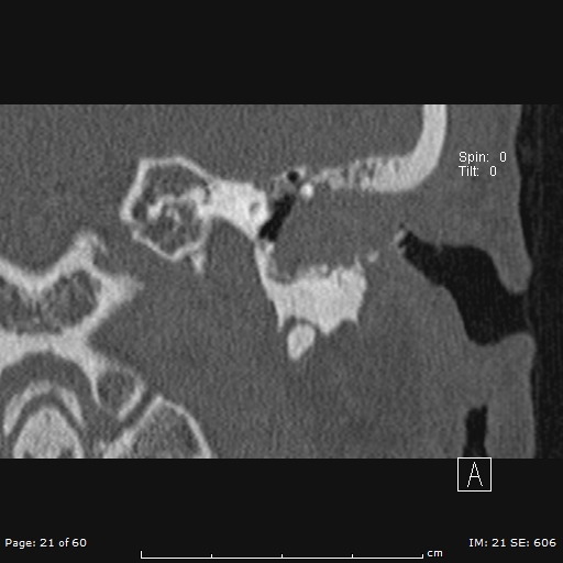 File:Cholesteatoma - external auditory canal (Radiopaedia 88452-105096 Coronal bone window 21).jpg