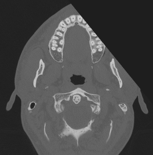 Chondrosarcoma (clivus) (Radiopaedia 46895-51425 Axial bone window 82).png