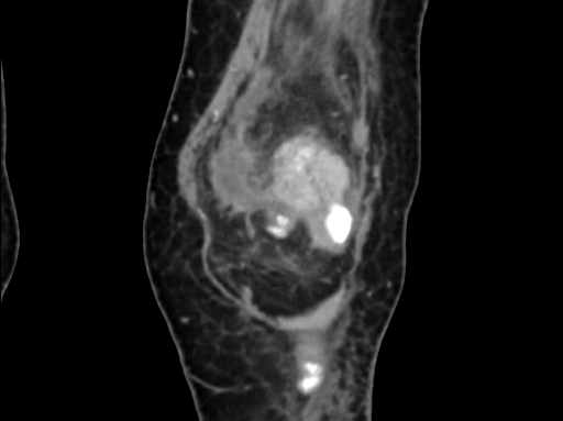 Chondrosarcoma - femur (Radiopaedia 64187-72954 C 14).jpg