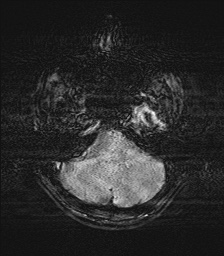 File:Chondrosarcoma - sphenoid wing (Radiopaedia 58259-67947 H 17).jpg