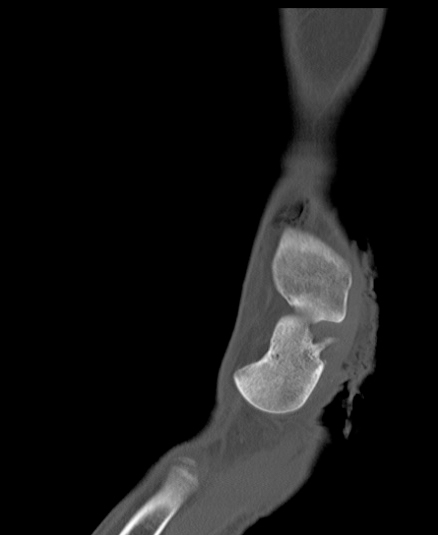 File:Chopart fracture (Radiopaedia 35347-36851 Sagittal bone window 20).jpg
